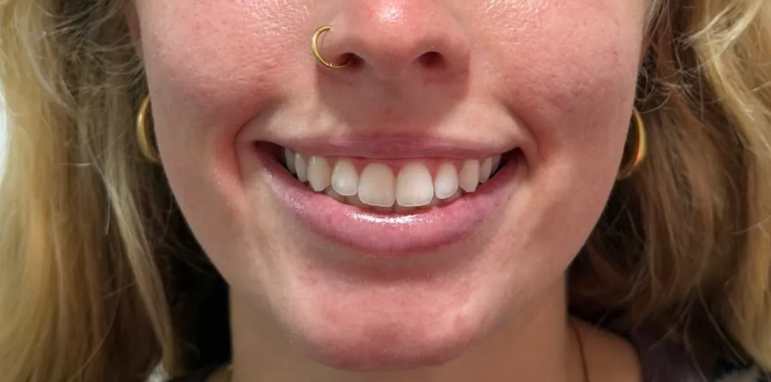Gummy Smile Treatment with botox - After Treatment