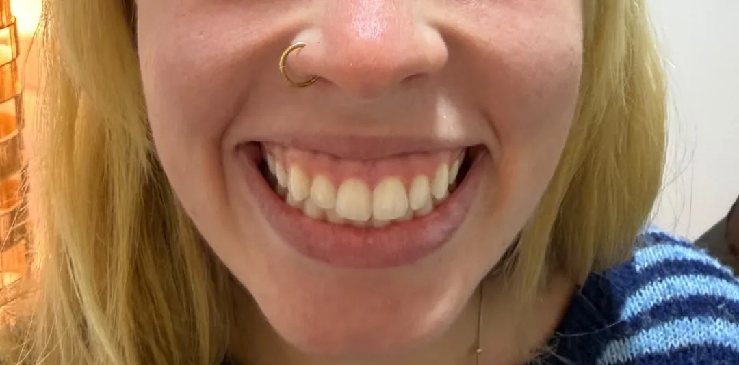 Gummy Smile Treatment with botox - Before Treatment