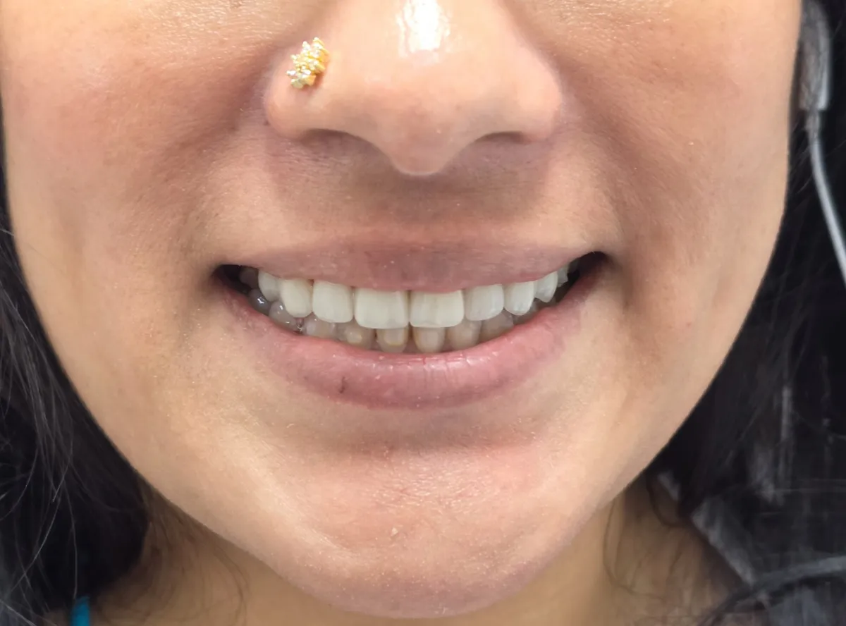 Veneers - After Treatment