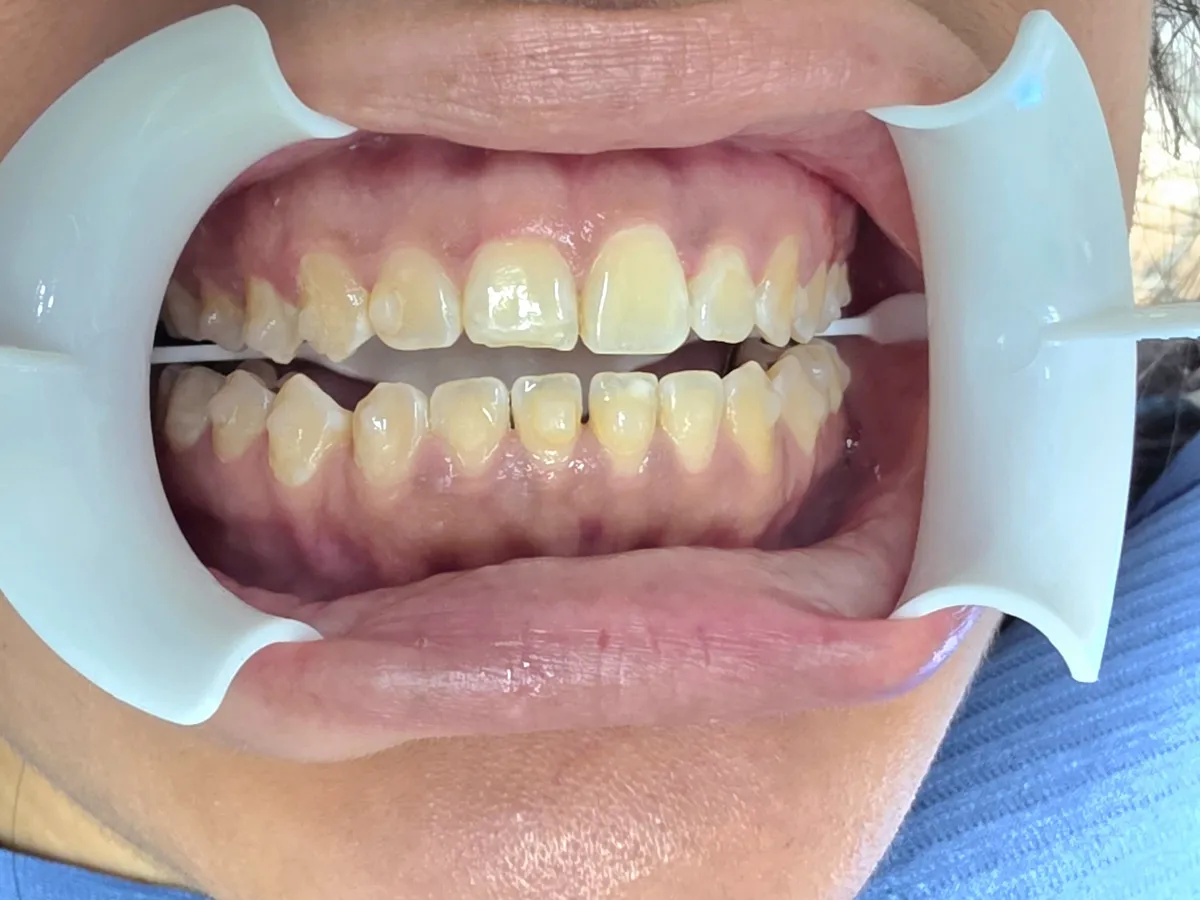 Veneers - Before Treatment